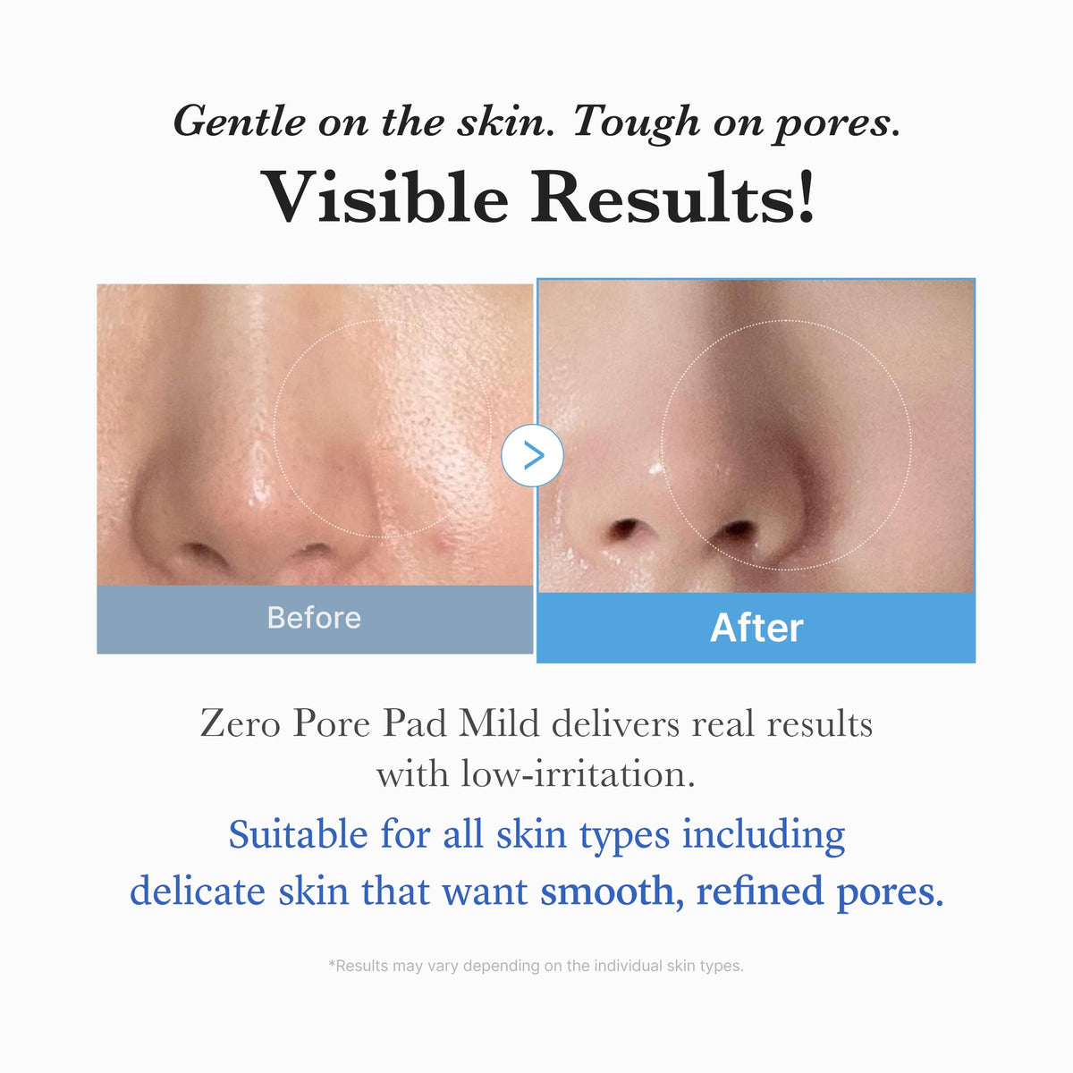 zero-pore-madecassoside-pads-mild-r5 04_6357f9f9-483b-4891-82c6-a58d336e62c8.jpg